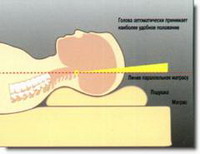 вынужденное положение головы