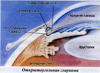 блокада угла передней камеры глаза