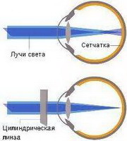 почему возникает астигматизм?