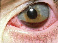 гифема - кровь в передней камере глаза