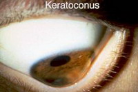 кератоконус