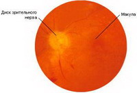 непроходимость артерии сетчатки