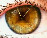 глаукома и дегенерация сетчатки